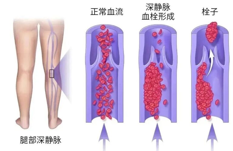 血管堵了？不止於溶栓！幹細胞再生“健康新血管”，改善心梗、腦中風後遺症