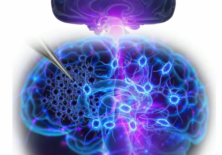 Nature 雙研究：iPSC 多巴胺神經元移植，帕金森氏症對因治療現曙光